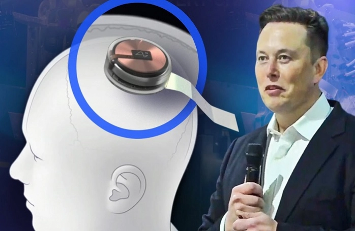 Startup công nghệ thần kinh của tỷ phú Elon Musk sắp thử nghiệm cấy chip vào não người